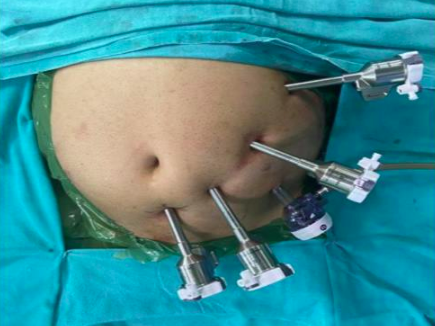 Laparoscopic Surgery